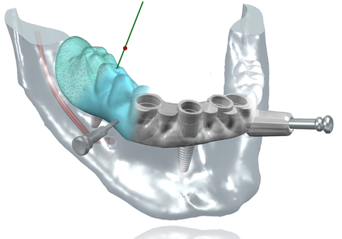 Implant dentaire Lyon