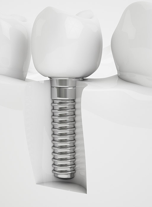 Implant dentaire Lyon